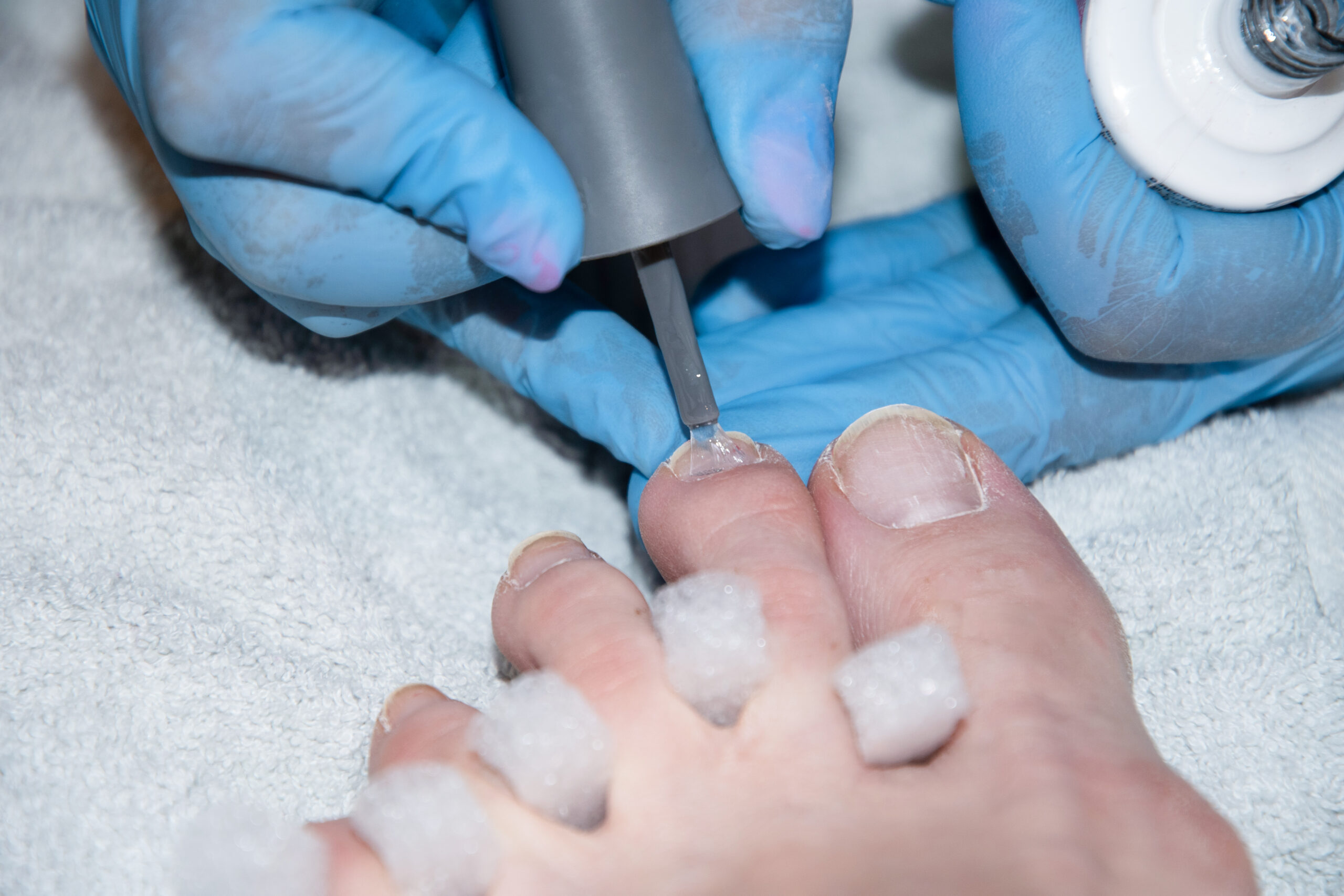  Fungal Nail Treatments 